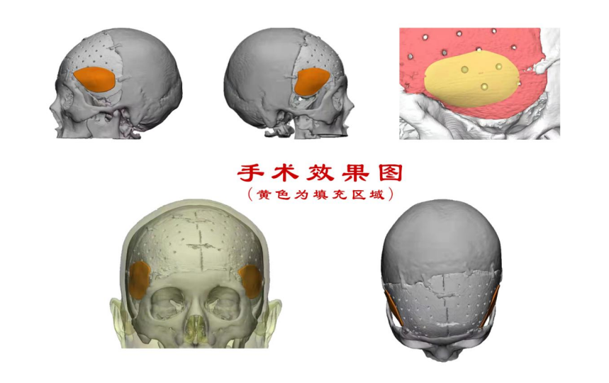 林志穎車禍致顏面骨折，醫生：或可用3D打印建模進行術后修復