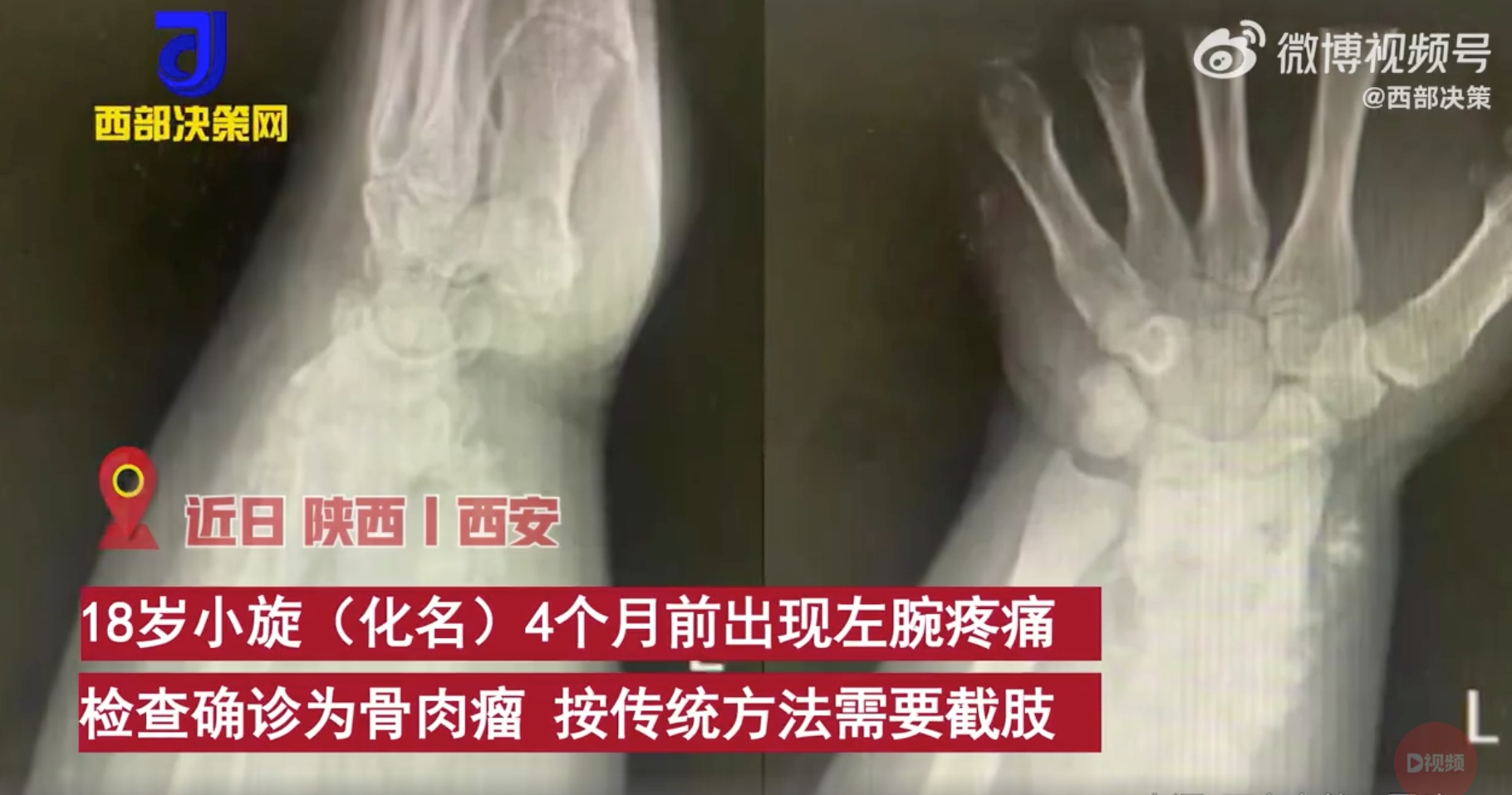 3D打印保住骨肉瘤患者左手,這項“黑科技”還能干點啥