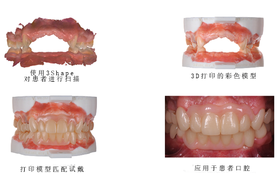 3Shape彩色工作流程，讓牙齒假體越來越“真”！