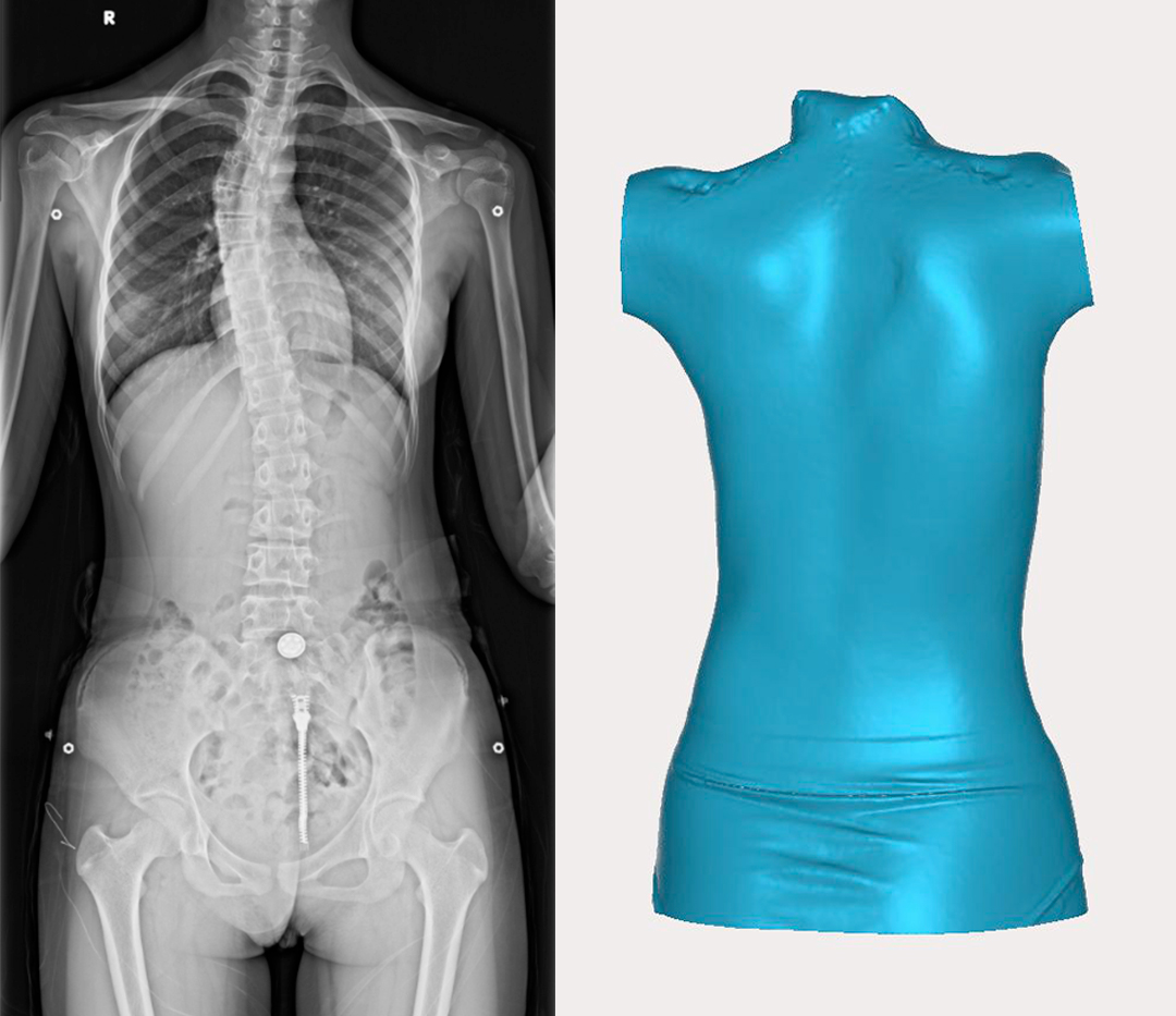 GREENSCANR系列3D掃描儀在脊柱矯正治療中的應(yīng)用